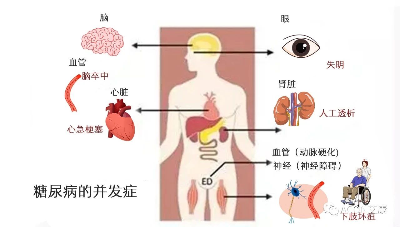 爆上热搜，因爆发型糖尿病进入ICU，有哪些教训值得我们汲取
